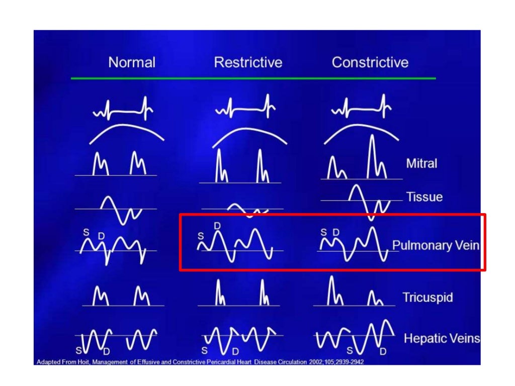 Echo Differentiation of Restrictive Cardiomyopathy and Constrictive P…