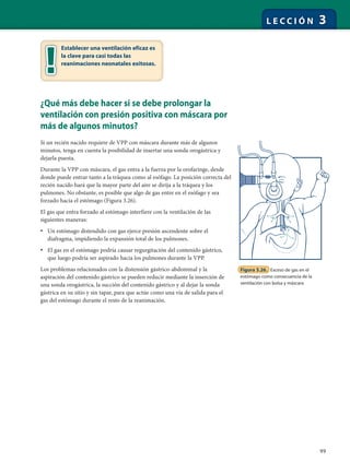 99
L E C C I Ó N 3
¿Qué más debe hacer si se debe prolongar la
ventilación con presión positiva con máscara por
más de algunos minutos?
Si un recién nacido requiere de VPP con máscara durante más de algunos
minutos, tenga en cuenta la posibilidad de insertar una sonda orogástrica y
dejarla puesta.
Durante la VPP con máscara, el gas entra a la fuerza por la orofaringe, desde
donde puede entrar tanto a la tráquea como al esófago. La posición correcta del
recién nacido hará que la mayor parte del aire se dirija a la tráquea y los
pulmones. No obstante, es posible que algo de gas entre en el esófago y sea
forzado hacia el estómago (Figura 3.26).
El gas que entra forzado al estómago interfiere con la ventilación de las
siguientes maneras:
• Un estómago distendido con gas ejerce presión ascendente sobre el
diafragma, impidiendo la expansión total de los pulmones.
• El gas en el estómago podría causar regurgitación del contenido gástrico,
que luego podría ser aspirado hacia los pulmones durante la VPP.
Los problemas relacionados con la distensión gástrico-abdominal y la
aspiración del contenido gástrico se pueden reducir mediante la inserción de
una sonda orogástrica, la succión del contenido gástrico y al dejar la sonda
gástrica en su sitio y sin tapar, para que actúe como una vía de salida para el
gas del estómago durante el resto de la reanimación.
Establecer una ventilación eficaz es
la clave para casi todas las
reanimaciones neonatales exitosas.
Figura 3.26. Exceso de gas en el
estómago como consecuencia de la
ventilación con bolsa y máscara
 