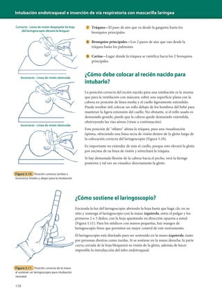 Intubación endotraqueal e inserción de vía respiratoria con mascarilla laríngea
170
Tráquea—El paso de aire que va desde la garganta hasta los
bronquios principales
Bronquios principales—Los 2 pasos de aire que van desde la
tráquea hasta los pulmones
Carina—Lugar donde la tráquea se ramifica hacia los 2 bronquios
principales
¿Cómo debe colocar al recién nacido para
intubarlo?
La posición correcta del recién nacido para una intubación es la misma
que para la ventilación con máscara: sobre una superficie plana con la
cabeza en posición de línea media y el cuello ligeramente extendido.
Puede resultar útil colocar un rollo debajo de los hombros del bebé para
mantener la ligera extensión del cuello. No obstante, si el rollo usado es
demasiado grande, puede que la cabeza quede demasiado extendida,
obstruyendo las vías aéreas (véase a continuación).
Esta posición de "olfateo" alinea la tráquea, para una visualización
óptima, ofreciendo una línea recta de visión dentro de la glotis luego de
la colocación correcta del laringoscopio (Figura 5.10).
Es importante no extender de más el cuello, porque esto elevará la glotis
por encima de su línea de visión y estrechará la tráquea.
Si hay demasiada flexión de la cabeza hacia el pecho, verá la faringe
posterior y tal vez no visualice directamente la glotis.
Correcto - Línea de visión despejada (la hoja
del laringoscopio elevará la lengua)
Incorrecto - Línea de visión obstruida
Incorrecto - Línea de visión obstruida
Figura 5.10. Posición correcta (arriba) e
incorrecta (medio y abajo) para la intubación
Figura 5.11. Posición correcta de la mano
al sostener un laringoscopio para intubación
neonatal
¿Cómo sostiene el laringoscopio?
Encienda la luz del laringoscopio abriendo la hoja hasta que haga clic en su
sitio y sostenga el laringoscopio con la mano izquierda, entre el pulgar y los
primeros 2 o 3 dedos, con la hoja apuntando en dirección opuesta a usted
(Figura 5.11). Para los médicos con manos pequeñas, hay mangos de
laringoscopio finos que permiten un mejor control de este instrumento.
El laringoscopio está diseñado para ser sostenido en la mano izquierda, tanto
por personas diestras como zurdas. Si se sostiene en la mano derecha, la parte
curva cerrada de la hoja bloqueará su visión de la glotis, además de hacer
imposible la introducción del tubo endotraqueal.
 