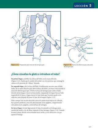 171
L E C C I Ó N 5
¿Cómo visualiza la glotis e introduce el tubo?
En primer lugar, estabilice la cabeza del bebé con la mano derecha
(Figura 5.12). Puede que le resulte útil contar con otra persona que sostenga la
cabeza en la posición de "olfateo" deseada.
En segundo lugar, abra la boca del bebé. Posiblemente necesite usar el dedo
índice de la mano derecha para abrir la boca del bebé y así hacer más sencilla la
inserción del laringoscopio. Deslice la hoja del laringoscopio sobre el lado
derecho de la lengua y hacia la línea media, empujando la lengua hacia el lado
izquierdo de la boca, y haga avanzar la hoja hasta que la punta quede en la
valécula, justo después de pasar la base de la lengua (Figura 5.13).
Nota: aunque esta lección describe colocar la punta de la hoja en la valécula,
hay quienes prefieren colocarla directamente en la epiglotis, comprimiendo
delicadamente la epiglotis contra la base de la lengua.
En tercer lugar, levante ligeramente la hoja, levantando así la lengua para
sacarla del medio a fin de dejar expuesta el área faríngea (Figura 5.14). Cuando
levante la hoja, elévela entera tirando hacia arriba y en la dirección a la que
apunta el mango.
Figura 5.12. Preparación para inserción de laringoscopio
Lengua
Valécula
Epiglotis
Figura 5.13. Puntos de referencia para colocación
de laringoscopio
 