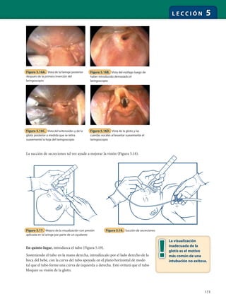 173
L E C C I Ó N 5
La succión de secreciones tal vez ayude a mejorar la visión (Figura 5.18).
Figura 5.16A. Vista de la faringe posterior
después de la primera inserción del
laringoscopio
Figura 5.16B. Vista del esófago luego de
haber introducido demasiado el
laringoscopio
Figura 5.16C. Vista del aritenoides y de la
glotis posterior a medida que se retira
suavemente la hoja del laringoscopio
Figura 5.16D. Vista de la glotis y las
cuerdas vocales al levantar suavemente el
laringoscopio
Figura 5.17. Mejora de la visualización con presión
aplicada en la laringe por parte de un ayudante
Figura 5.18. Succión de secreciones
La visualización
inadecuada de la
glotis es el motivo
más común de una
intubación no exitosa.
En quinto lugar, introduzca el tubo (Figura 5.19).
Sosteniendo el tubo en la mano derecha, introdúzcalo por el lado derecho de la
boca del bebé, con la curva del tubo apoyada en el plano horizontal de modo
tal que el tubo forme una curva de izquierda a derecha. Esto evitará que el tubo
bloquee su visión de la glotis.
 