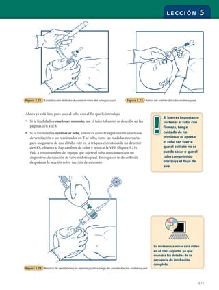 175
L E C C I Ó N 5
Ahora ya está listo para usar el tubo con el fin que lo introdujo.
• Si la finalidad es succionar meconio, use el tubo tal como se describe en las
páginas 176 a 178.
• Si la finalidad es ventilar al bebé, entonces conecte rápidamente una bolsa
de ventilación o un reanimador en T al tubo, tome las medidas necesarias
para asegurarse de que el tubo esté en la tráquea conectándole un detector
de CO2, observe si hay cambios de color y reinicie la VPP (Figura 5.23).
Pida a otro miembro del equipo que sujete el tubo con cinta o con un
dispositivo de sujeción de tubo endotraqueal. Estos pasos se describirán
después de la sección sobre succión de meconio.
Figura 5.21. Estabilización del tubo durante el retiro del laringoscopio Figura 5.22. Retiro del estilete del tubo endotraqueal
Si bien es importante
sostener el tubo con
firmeza, tenga
cuidado de no
presionar ni apretar
el tubo tan fuerte
que el estilete no se
pueda sacar o que el
tubo comprimido
obstruya el flujo de
aire.
Figura 5.23. Reinicio de ventilación con presión positiva luego de una intubación endotraqueal
Lo instamos a mirar este video
en el DVD adjunto, ya que
muestra los detalles de la
secuencia de intubación
completa.
 
