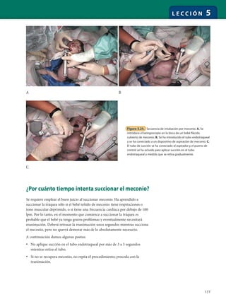 177
L E C C I Ó N 5
¿Por cuánto tiempo intenta succionar el meconio?
Se requiere emplear el buen juicio al succionar meconio. Ha aprendido a
succionar la tráquea sólo si el bebé teñido de meconio tiene respiraciones o
tono muscular deprimido, o si tiene una frecuencia cardíaca por debajo de 100
lpm. Por lo tanto, en el momento que comience a succionar la tráquea es
probable que el bebé ya tenga graves problemas y eventualmente necesitará
reanimación. Deberá retrasar la reanimación unos segundos mientras succiona
el meconio, pero no querrá demorar más de lo absolutamente necesario.
A continuación damos algunas pautas:
• No aplique succión en el tubo endotraqueal por más de 3 a 5 segundos
mientras retira el tubo.
• Si no se recupera meconio, no repita el procedimiento; proceda con la
reanimación.
Figura 5.25. Secuencia de intubación por meconio. A. Se
introduce el laringoscopio en la boca de un bebé flácido
cubierto de meconio. B. Se ha introducido el tubo endotraqueal
y se ha conectado a un dispositivo de aspiración de meconio. C.
El tubo de succión se ha conectado al aspirador y el puerto de
control se ha ocluido para aplicar succión en el tubo
endotraqueal a medida que se retira gradualmente.
A B
C
 