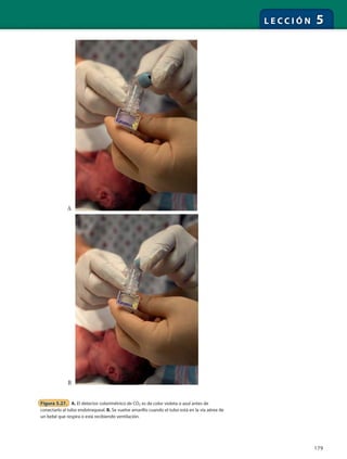 179
L E C C I Ó N 5
Figura 5.27. A. El detector colorimétrico de CO2 es de color violeta o azul antes de
conectarlo al tubo endotraqueal. B. Se vuelve amarillo cuando el tubo está en la vía aérea de
un bebé que respira o está recibiendo ventilación.
A
B
 