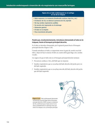 Intubación endotraqueal e inserción de vía respiratoria con mascarilla laríngea
186
Puede que, involuntariamente, introduzca demasiado el tubo en la
tráquea, hasta el bronquio principal derecho.
Si el tubo se introduce demasiado, por lo general pasará hacia el bronquio
principal derecho (Figura 5.34).
Cuando introduzca el tubo, es importante mirar la guía de cuerda vocal del
tubo y dejar de hacer avanzar el tubo en cuanto dicha guía llega a las cuerdas
vocales.
Los signos de que el tubo está en el bronquio principal derecho incluyen
• Frecuencia cardíaca o Spo2 del bebé que no mejoran.
• Sonidos respiratorios que se escuchan del lado derecho del pecho pero no
del lado izquierdo.
• Sonidos respiratorios que se escuchan más alto del lado derecho del pecho
que del lado izquierdo.
Signos de un tubo endotraqueal en el esófago
en vez de la tráquea
• Mala respuesta a la intubación (bradicardia continua, baja SPO2, etc.)
• El detector de CO2 no detecta la presencia de CO2 espirado
• No hay sonidos respiratorios audibles
• Se escucha aire ingresando en el estómago
• Distensión gástrica
• El tubo no se empaña
• Poco movimiento del pecho
Figura 5.34. Tubo endotraqueal demasiado
introducido (la punta llega hasta el bronquio
principal derecho). NOTA: aunque un detector
de CO2 confirmará que el tubo está en la vía
aérea, probablemente no distinga entre que
esté en la tráquea o en un bronquio principal.
 