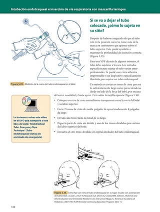 Intubación endotraqueal e inserción de vía respiratoria con mascarilla laríngea
188
Si se va a dejar el tubo
colocado, ¿cómo lo sujeta en
su sitio?
Después de haberse asegurado de que el tubo
está en la posición correcta, tome nota de la
marca en centímetros que aparece sobre el
labio superior. Esto puede ayudarlo a
mantener la profundidad de inserción correcta
(Figura 5.35).
Para una VPP de más de algunos minutos, el
tubo debe sujetarse a la cara. Los métodos
específicos para sujetar el tubo varían entre
profesionales. Se puede usar cinta adhesiva
impermeable o un dispositivo específicamente
diseñado para sujetar un tubo endotraqueal.
Un método es cortar un trozo de cinta que sea
lo suficientemente largo como para extenderse
desde un lado de la boca del bebé, por encima
del surco nasolabial y hasta aprox. 2 cm sobre la mejilla opuesta (Figura 5.36).
• Coloque una tira de cinta autoadhesiva transparente entre la nariz del bebé
y su labio superior.
• Corte 2 trozos de cinta de media pulgada, de aproximadamente 4 pulgadas
de largo.
• Divida cada trozo hasta la mitad de su largo.
• Pegue la parte de cinta sin dividir y uno de los trozos divididos por encima
del labio superior del bebé.
• Envuelva el otro trozo dividido en espiral alrededor del tubo endotraqueal.
13
12
9
10
11
Figura 5.35. Medición de la marca del tubo endotraqueal en el labio
Figura 5.36. Cómo fijar con cinta el tubo endotraqueal en su lugar. (Usado con autorización
de Kattwinkel J, Cook LJ, Hurt H, Nowacek GA, Short JG, Crosby WM, editores. Maternal and
Fetal Evaluation and Immediate Newborn Care. Elk Grove Village, IL: American Acadamy of
Pediatrics; 2007:199. PCEP Perinatal Continuing Education Program; libro 1.)
Lo instamos a mirar este video
en el DVD que acompaña a este
libro de texto: "Endotracheal
Tube: Emergency Tape
Technique" (Tubo
endotraqueal: técnica de
encintado de emergencia)
 