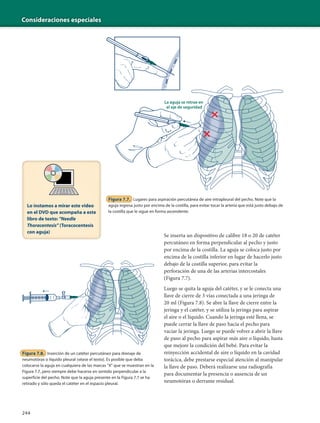 Consideraciones especiales
244
Se inserta un dispositivo de calibre 18 o 20 de catéter
percutáneo en forma perpendicular al pecho y justo
por encima de la costilla. La aguja se coloca justo por
encima de la costilla inferior en lugar de hacerlo justo
debajo de la costilla superior, para evitar la
perforación de una de las arterias intercostales
(Figura 7.7).
Luego se quita la aguja del catéter, y se le conecta una
llave de cierre de 3 vías conectada a una jeringa de
20 ml (Figura 7.8). Se abre la llave de cierre entre la
jeringa y el catéter, y se utiliza la jeringa para aspirar
el aire o el líquido. Cuando la jeringa esté llena, se
puede cerrar la llave de paso hacia el pecho para
vaciar la jeringa. Luego se puede volver a abrir la llave
de paso al pecho para aspirar más aire o líquido, hasta
que mejore la condición del bebé. Para evitar la
reinyección accidental de aire o líquido en la cavidad
torácica, debe prestarse especial atención al manipular
la llave de paso. Deberá realizarse una radiografía
para documentar la presencia o ausencia de un
neumotórax o derrame residual.
Figura 7.8. Inserción de un catéter percutáneo para drenaje de
neumotórax o líquido pleural (véase el texto). Es posible que deba
colocarse la aguja en cualquiera de las marcas "X" que se muestran en la
Figura 7.7, pero siempre debe hacerse en sentido perpendicular a la
superficie del pecho. Note que la aguja presente en la Figura 7.7 se ha
retirado y sólo queda el catéter en el espacio pleural.
La aguja se retrae en
el eje de seguridad
Figura 7.7. Lugares para aspiración percutánea de aire intrapleural del pecho. Note que la
aguja ingresa justo por encima de la costilla, para evitar tocar la arteria que está justo debajo de
la costilla que le sigue en forma ascendente.
Lo instamos a mirar este video
en el DVD que acompaña a este
libro de texto: "Needle
Thoracentesis" (Toracocentesis
con aguja)
 
