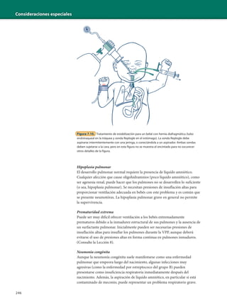 Consideraciones especiales
246
Hipoplasia pulmonar
El desarrollo pulmonar normal requiere la presencia de líquido amniótico.
Cualquier afección que cause oligohidramnios (poco líquido amniótico), como
ser agenesia renal, puede hacer que los pulmones no se desarrollen lo suficiente
(o sea, hipoplasia pulmonar). Se necesitan presiones de insuflación altas para
proporcionar ventilación adecuada en bebés con este problema y es común que
se presente neumotórax. La hipoplasia pulmonar grave en general no permite
la supervivencia.
Prematuridad extrema
Puede ser muy difícil ofrecer ventilación a los bebés extremadamente
prematuros debido a la inmadurez estructural de sus pulmones y la ausencia de
un surfactante pulmonar. Inicialmente pueden ser necesarias presiones de
insuflación altas para insuflar los pulmones durante la VPP, aunque deberá
evitarse el uso de presiones altas en forma continua en pulmones inmaduros.
(Consulte la Lección 8).
Neumonía congénita
Aunque la neumonía congénita suele manifestarse como una enfermedad
pulmonar que empeora luego del nacimiento, algunas infecciones muy
agresivas (como la enfermedad por estreptococo del grupo B) pueden
presentarse como insuficiencia respiratoria inmediatamente después del
nacimiento. Además, la aspiración de líquido amniótico, en particular si está
contaminado de meconio, puede representar un problema respiratorio grave.
Figura 7.10. Tratamiento de estabilización para un bebé con hernia diafragmática (tubo
endotraqueal en la tráquea y sonda Replogle en el estómago). La sonda Replogle debe
aspirarse intermitentemente con una jeringa, o conectándola a un aspirador. Ambas sondas
deben sujetarse a la cara, pero en esta figura no se muestra el encintado para no oscurecer
otros detalles de la figura.
 