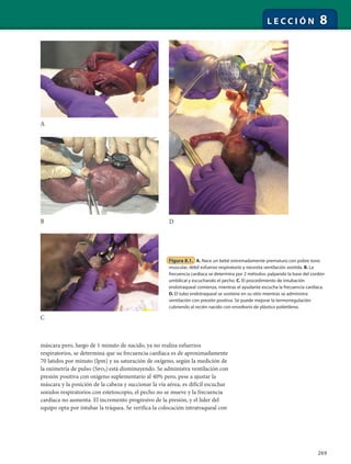 269
L E C C I Ó N 8
Figura 8.1. A. Nace un bebé extremadamente prematuro con pobre tono
muscular, débil esfuerzo respiratorio y necesita ventilación asistida. B. La
frecuencia cardíaca se determina por 2 métodos: palpando la base del cordón
umbilical y escuchando el pecho. C. El procedimiento de intubación
endotraqueal comienza, mientras el ayudante escucha la frecuencia cardíaca.
D. El tubo endotraqueal se sostiene en su sitio mientras se administra
ventilación con presión positiva. Se puede mejorar la termorregulación
cubriendo al recién nacido con envoltorio de plástico polietileno.
A
B
C
D
máscara pero, luego de 1 minuto de nacido, ya no realiza esfuerzos
respiratorios, se determina que su frecuencia cardíaca es de aproximadamente
70 latidos por minuto (lpm) y su saturación de oxígeno, según la medición de
la oximetría de pulso (Spo2) está disminuyendo. Se administra ventilación con
presión positiva con oxígeno suplementario al 40% pero, pese a ajustar la
máscara y la posición de la cabeza y succionar la vía aérea, es difícil escuchar
sonidos respiratorios con estetoscopio, el pecho no se mueve y la frecuencia
cardíaca no aumenta. El incremento progresivo de la presión, y el líder del
equipo opta por intubar la tráquea. Se verifica la colocación intratraqueal con
 