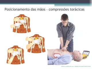 Posicionamento das mãos – compressões torácicas
FONTE: GUIDELINE 2010. AMERICAN HEART ASSOCIATON.
 