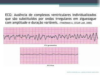 ECG: Ausência de complexos ventriculares individualizados
que são substituídos por ondas irregulares em ziguezague
com amplitude e duração variáveis. (TIMERMAN A, CESAR LAM, 2000)
FONTE: GUIDELINE 2010. AMERICAN HEART ASSOCIATON.
 