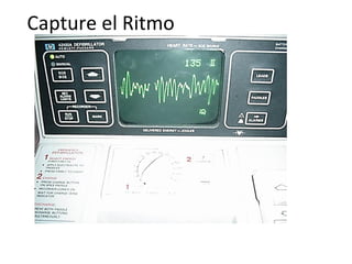 Capture el Ritmo

En este caso vea como no hay complejos QRS anormales y el patrón es caótico e
irregular.

 