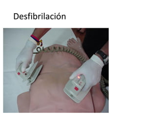 Desfibrilación
Oprima el botón de
carga para cargar los
200 joules.
En este caso el botón
es el de color rojo que
oprime el pulgar
derecho del
reanimador.

 