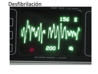 Desfibrilación

Aparece la cifra de carga en la pantalla y se emite un sonido constante que
indica que ya se cargó.

 