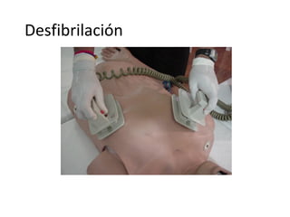 Desfibrilación

Proporcione la primera descarga oprimiendo simultaneamente los
botones de cada paleta. En este caso se oprimen con ambos índices
del reanimador. Aplique de inmediato dos minutos de RCP

 