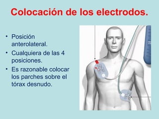 Colocación de los electrodos.
• Posición
anterolateral.
• Cualquiera de las 4
posiciones.
• Es razonable colocar
los parches sobre el
tórax desnudo.
 