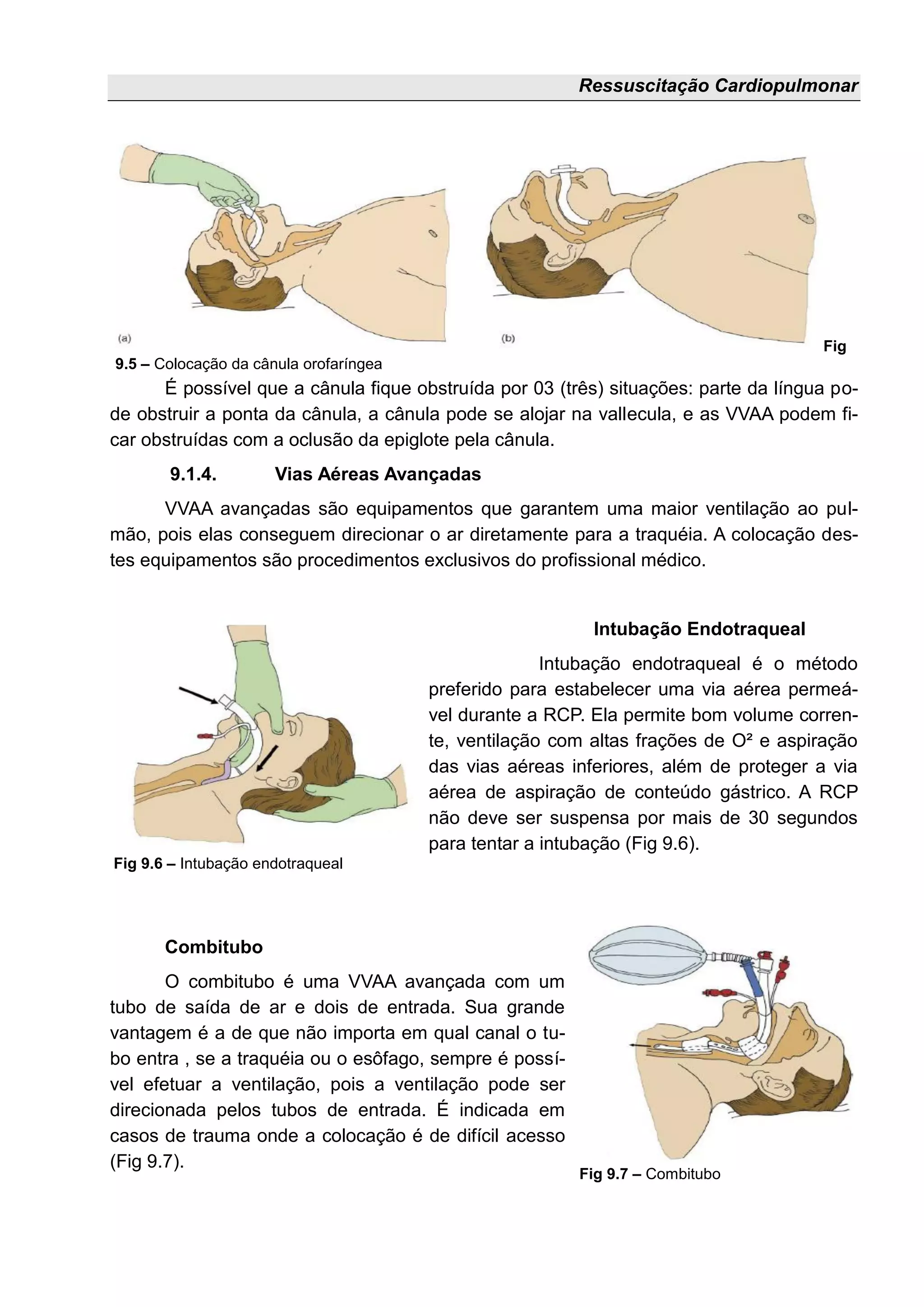Ressuscitação Cardiopulmonar
É possível que a cânula fique obstruída por 03 (três) situações: parte da língua po-
de obstruir a ponta da cânula, a cânula pode se alojar na vallecula, e as VVAA podem fi-
car obstruídas com a oclusão da epiglote pela cânula.
9.1.4. Vias Aéreas Avançadas
VVAA avançadas são equipamentos que garantem uma maior ventilação ao pul-
mão, pois elas conseguem direcionar o ar diretamente para a traquéia. A colocação des-
tes equipamentos são procedimentos exclusivos do profissional médico.
Intubação Endotraqueal
Intubação endotraqueal é o método
preferido para estabelecer uma via aérea permeá-
vel durante a RCP. Ela permite bom volume corren-
te, ventilação com altas frações de O² e aspiração
das vias aéreas inferiores, além de proteger a via
aérea de aspiração de conteúdo gástrico. A RCP
não deve ser suspensa por mais de 30 segundos
para tentar a intubação (Fig 9.6).
Combitubo
O combitubo é uma VVAA avançada com um
tubo de saída de ar e dois de entrada. Sua grande
vantagem é a de que não importa em qual canal o tu-
bo entra , se a traquéia ou o esôfago, sempre é possí-
vel efetuar a ventilação, pois a ventilação pode ser
direcionada pelos tubos de entrada. É indicada em
casos de trauma onde a colocação é de difícil acesso
(Fig 9.7).
Fig
9.5 – Colocação da cânula orofaríngea
Fig 9.7 – Combitubo
Fig 9.6 – Intubação endotraqueal
 