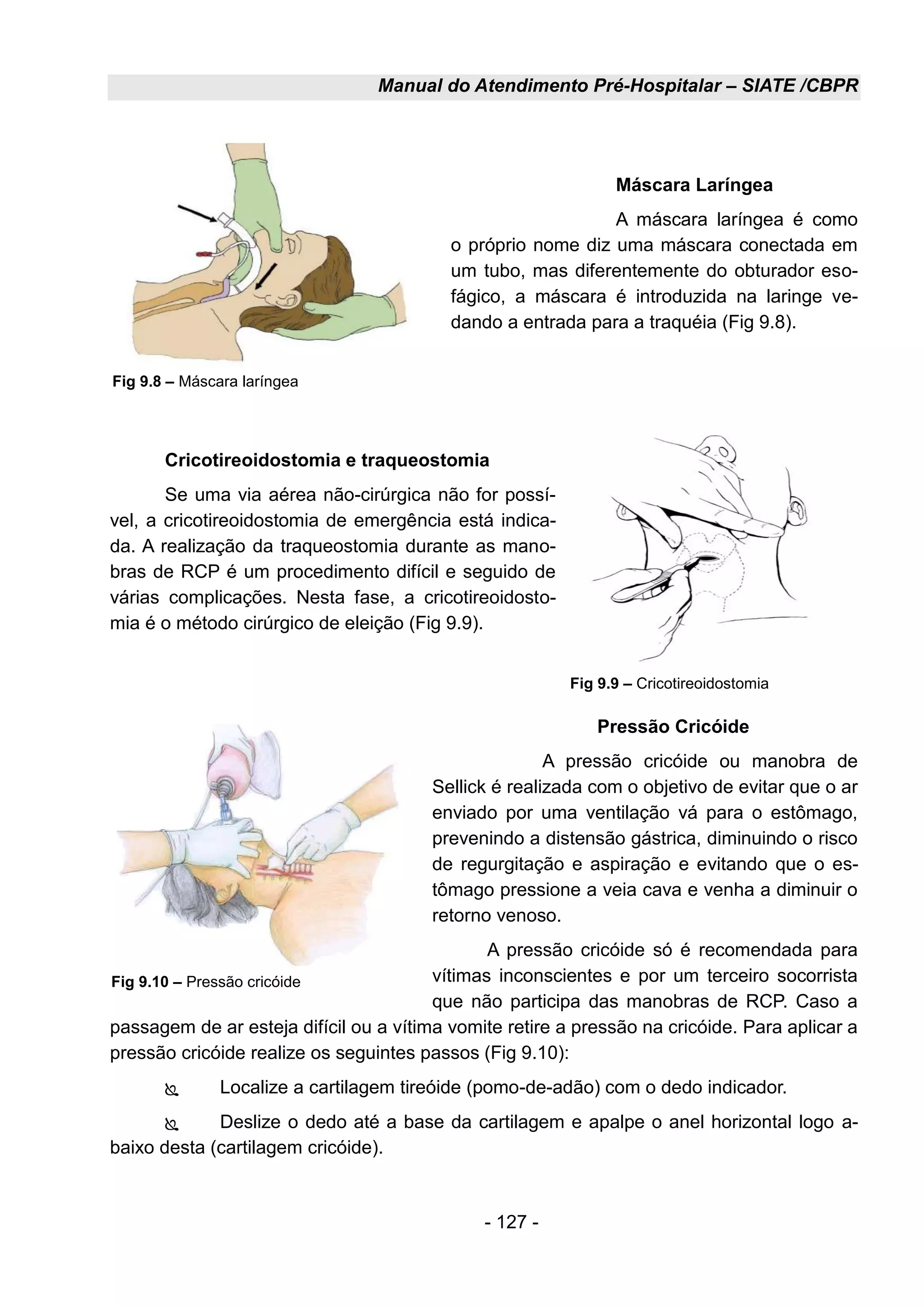 Manual do Atendimento Pré-Hospitalar – SIATE /CBPR
- 127 -
Máscara Laríngea
A máscara laríngea é como
o próprio nome diz uma máscara conectada em
um tubo, mas diferentemente do obturador eso-
fágico, a máscara é introduzida na laringe ve-
dando a entrada para a traquéia (Fig 9.8).
Cricotireoidostomia e traqueostomia
Se uma via aérea não-cirúrgica não for possí-
vel, a cricotireoidostomia de emergência está indica-
da. A realização da traqueostomia durante as mano-
bras de RCP é um procedimento difícil e seguido de
várias complicações. Nesta fase, a cricotireoidosto-
mia é o método cirúrgico de eleição (Fig 9.9).
Pressão Cricóide
A pressão cricóide ou manobra de
Sellick é realizada com o objetivo de evitar que o ar
enviado por uma ventilação vá para o estômago,
prevenindo a distensão gástrica, diminuindo o risco
de regurgitação e aspiração e evitando que o es-
tômago pressione a veia cava e venha a diminuir o
retorno venoso.
A pressão cricóide só é recomendada para
vítimas inconscientes e por um terceiro socorrista
que não participa das manobras de RCP. Caso a
passagem de ar esteja difícil ou a vítima vomite retire a pressão na cricóide. Para aplicar a
pressão cricóide realize os seguintes passos (Fig 9.10):
 Localize a cartilagem tireóide (pomo-de-adão) com o dedo indicador.
 Deslize o dedo até a base da cartilagem e apalpe o anel horizontal logo a-
baixo desta (cartilagem cricóide).
Fig 9.8 – Máscara laríngea
Fig 9.9 – Cricotireoidostomia
Fig 9.10 – Pressão cricóide
 