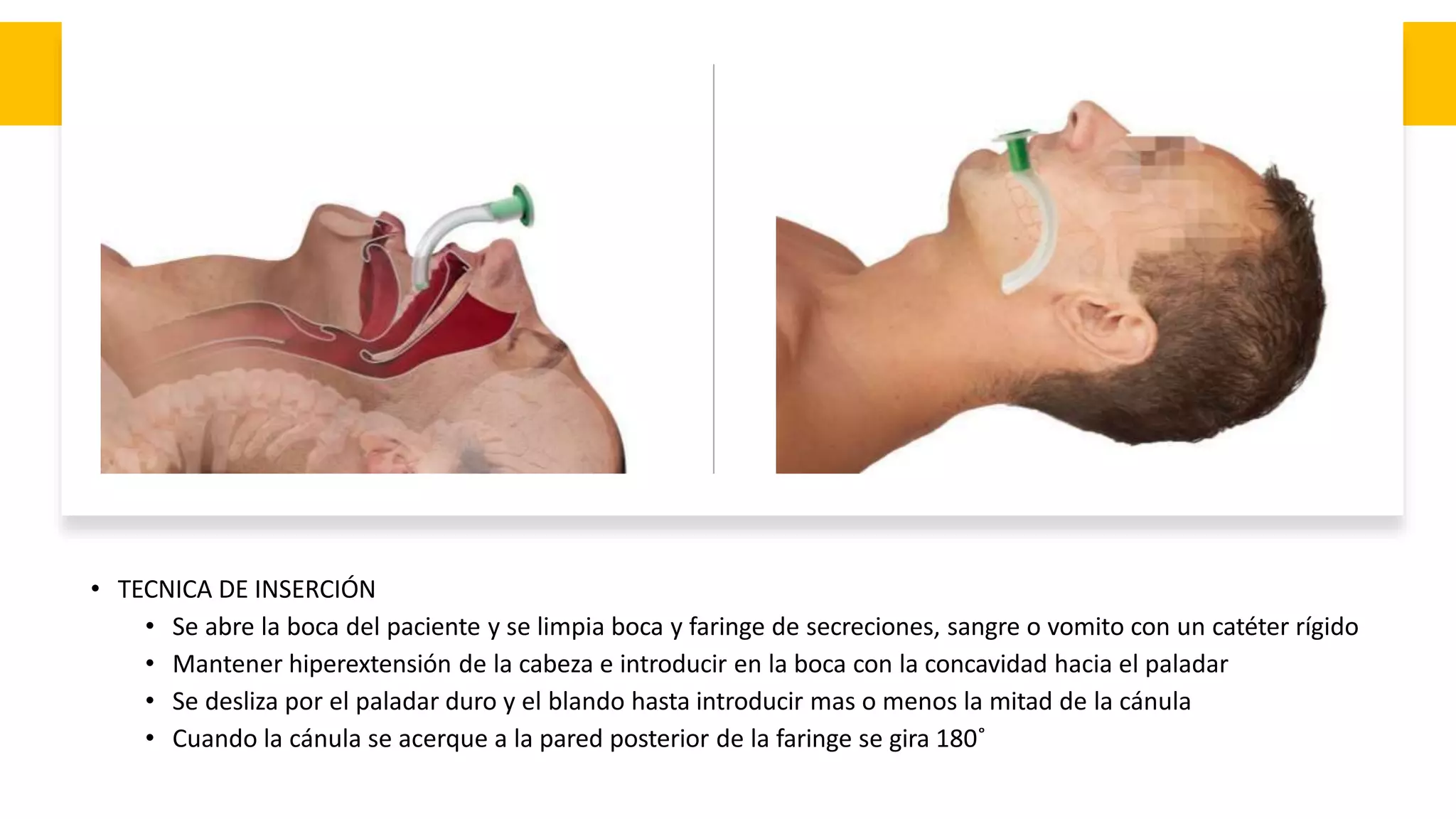 • TECNICA DE INSERCIÓN
• Se abre la boca del paciente y se limpia boca y faringe de secreciones, sangre o vomito con un catéter rígido
• Mantener hiperextensión de la cabeza e introducir en la boca con la concavidad hacia el paladar
• Se desliza por el paladar duro y el blando hasta introducir mas o menos la mitad de la cánula
• Cuando la cánula se acerque a la pared posterior de la faringe se gira 180˚
 