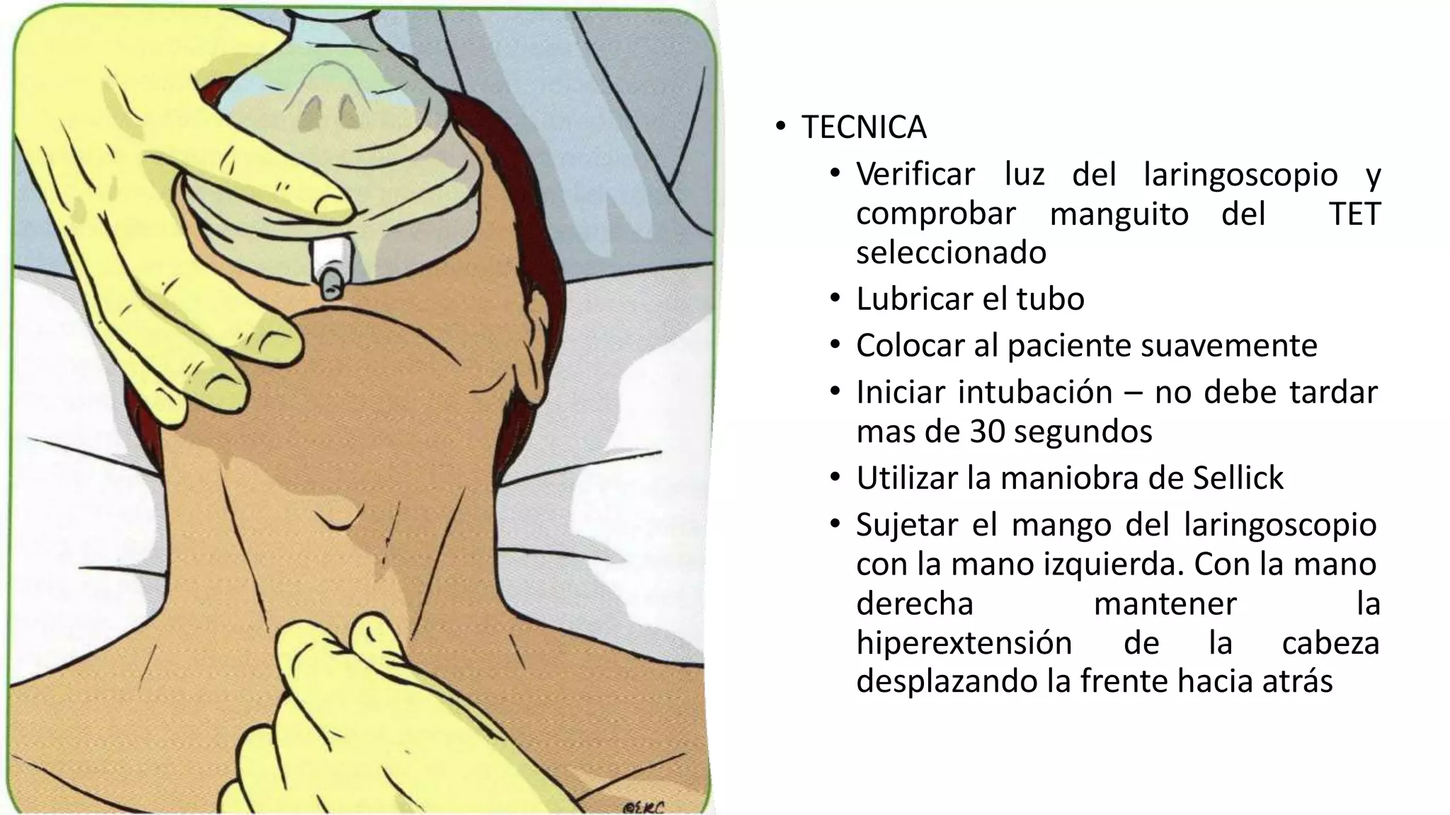 del laringoscopio y
manguito del TET
• TECNICA
• Verificar luz
comprobar
seleccionado
• Lubricar el tubo
• Colocar al paciente suavemente
• Iniciar intubación – no debe tardar
mas de 30 segundos
• Utilizar la maniobra de Sellick
• Sujetar el mango del laringoscopio
con la mano izquierda. Con la mano
derecha mantener
hiperextensión de la
la
cabeza
desplazando la frente hacia atrás
 