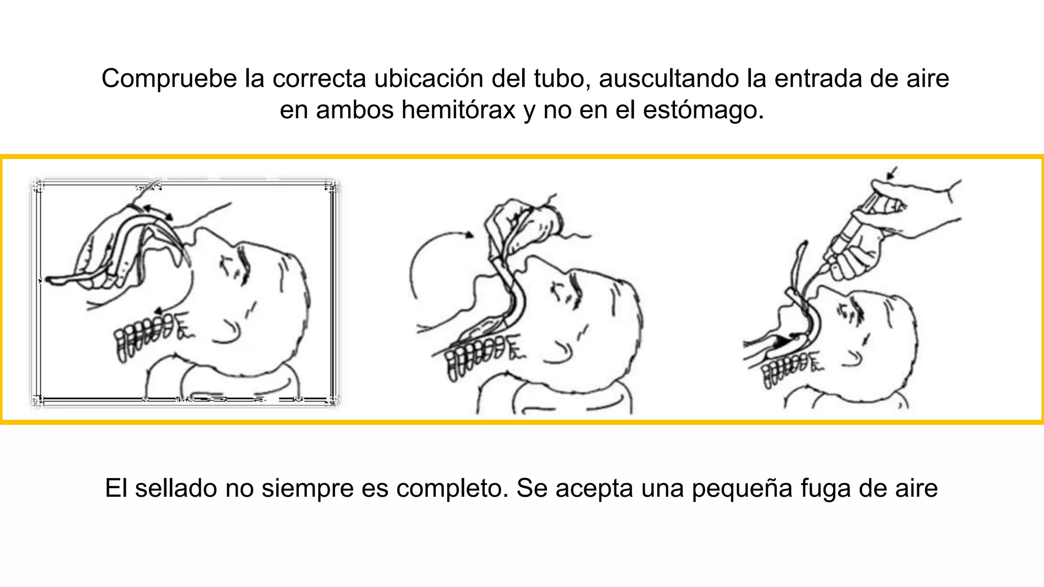 Compruebe la correcta ubicación del tubo, auscultando la entrada de aire
en ambos hemitórax y no en el estómago.
El sellado no siempre es completo. Se acepta una pequeña fuga de aire
 