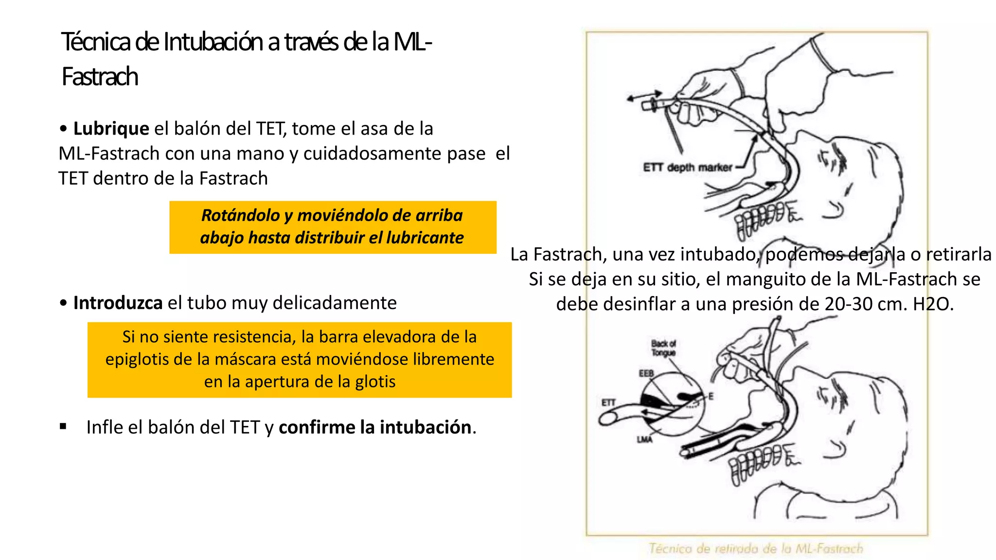 La Fastrach, una vez intubado, podemos dejarla o retirarla
Si se deja en su sitio, el manguito de la ML-Fastrach se
debe desinflar a una presión de 20-30 cm. H2O.
• Lubrique el balón del TET, tome el asa de la
ML-Fastrach con una mano y cuidadosamente pase el
TET dentro de la Fastrach
• Introduzca el tubo muy delicadamente
 Infle el balón del TET y confirme la intubación.
Rotándolo y moviéndolo de arriba
abajo hasta distribuir el lubricante
Si no siente resistencia, la barra elevadora de la
epiglotis de la máscara está moviéndose libremente
en la apertura de la glotis
TécnicadeIntubaciónatravésdelaML-
Fastrach
 