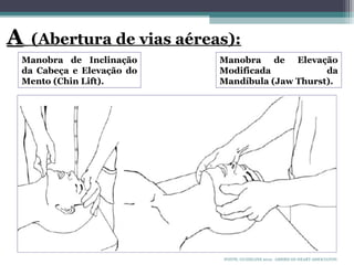 FONTE: GUIDELINE 2010. AMERICAN HEART ASSOCIATON.
Manobra de Inclinação
da Cabeça e Elevação do
Mento (Chin Lift).
Manobra de Elevação
Modificada da
Mandíbula (Jaw Thurst).
A
A (Abertura de vias aéreas):
 