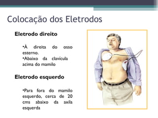 Colocação dos Eletrodos
Eletrodo direito
•À direita do osso
esterno.
•Abaixo da clavícula
acima do mamilo
Eletrodo esquerdo
•Para fora do mamilo
esquerdo, cerca de 20
cms abaixo da axila
esquerda
 