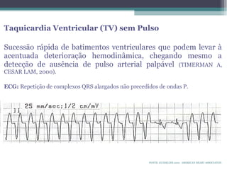 Taquicardia Ventricular (TV) sem Pulso
Sucessão rápida de batimentos ventriculares que podem levar à
acentuada deterioração hemodinâmica, chegando mesmo a
detecção de ausência de pulso arterial palpável (TIMERMAN A,
CESAR LAM, 2000).
ECG: Repetição de complexos QRS alargados não precedidos de ondas P.
FONTE: GUIDELINE 2010. AMERICAN HEART ASSOCIATON.
 