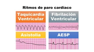 Ritmos de paro cardíaco
Taquicardia
Ventricular
Fibrilación
Ventricular
Asistolia AESP
 