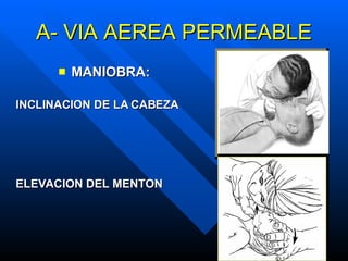 A- VIA AEREA PERMEABLE MANIOBRA: INCLINACION DE LA CABEZA ELEVACION DEL MENTON 