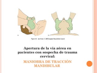 Apertura de la vía aérea en
pacientes con sospecha de trauma
            cervical:
   MANIOBRA DE TRACCIÓN
       MANDIBULAR
 