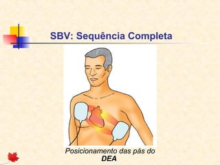 SBV: Sequência Completa

Posicionamento das pás do
DEA

 