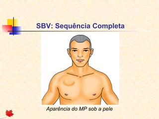 SBV: Sequência Completa

Aparência do MP sob a pele

 