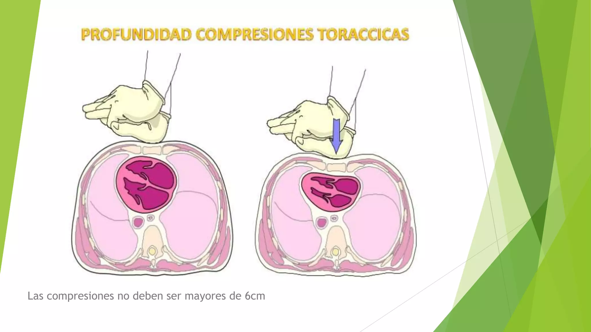 Las compresiones no deben ser mayores de 6cm
 