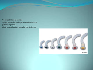 Colocación de la cánula Entrar la cánula con la parte cóncava hacia el paladar superior. Girar la cánula 180º e introducirla sin forzar. 