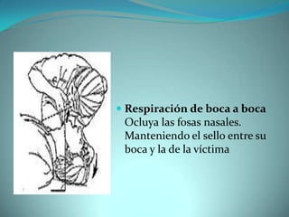 Respiración de boca a bocaOcluya las fosas nasales. Manteniendo el sello entre su boca y la de la víctima