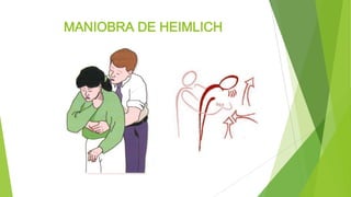 MANIOBRA DE HEIMLICH
 