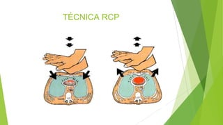 TÉCNICA RCP
 