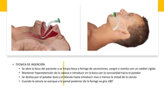 • TECNICA DE INSERCIÓN
• Se abre la boca del paciente y se limpia boca y faringe de secreciones, sangre o vomito con un catéter rígido
• Mantener hiperextensión de la cabeza e introducir en la boca con la concavidad hacia el paladar
• Se desliza por el paladar duro y el blando hasta introducir mas o menos la mitad de la cánula
• Cuando la cánula se acerque a la pared posterior de la faringe se gira 180˚
 