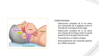 • COMPLICACIONES
• Obstrucción completa de la vía aérea
por compresión de la epiglotis contra la
entrada de la laringe (Cánula larga)
• Obstrucción completa de la vía aérea
por empuje de la lengua contra la pared
posterior de la faringe (Cánula corta)
• Traumatismos: en labios y lengua
• Broncoaspiración del contenido gástrico
por reflejo nauseoso
 