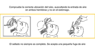 Compruebe la correcta ubicación del tubo, auscultando la entrada de aire
en ambos hemitórax y no en el estómago.
El sellado no siempre es completo. Se acepta una pequeña fuga de aire
 