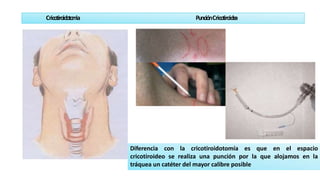 Cricotiroidoto
m
ia PunciónCricotiroide
a
Diferencia con la cricotiroidotomía es que en el espacio
cricotiroideo se realiza una punción por la que alojamos en la
tráquea un catéter del mayor calibre posible
 