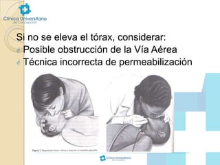 Si no se eleva el tórax, considerar:
 Posible obstrucción de la Vía Aérea
 Técnica incorrecta de permeabilización

 