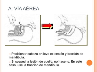 A: VÍA AÉREA
Posicionar cabeza en leve extensión y tracción de
mandíbula.
Si sospecha lesión de cuello, no hacerlo. En este
caso, use la tracción de mandíbula.
 