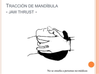 TRACCIÓN DE MANDÍBULA
- JAW THRUST -
No se enseña a personas no-médicas
 