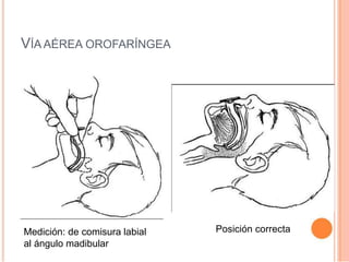 VÍA AÉREA OROFARÍNGEA
Medición: de comisura labial
al ángulo madibular
Posición correcta
 