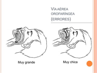 VÍA AÉREA
OROFARÍNGEA
(ERRORES)
Muy grande Muy chica
 