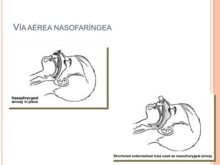 VÍA AÉREA NASOFARÍNGEA
 