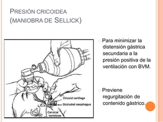 PRESIÓN CRICOIDEA
(MANIOBRA DE SELLICK)
Para minimizar la
distensión gástrica
secundaria a la
presión positiva de la
ventilación con BVM.
Previene
regurgitación de
contenido gástrico.
 